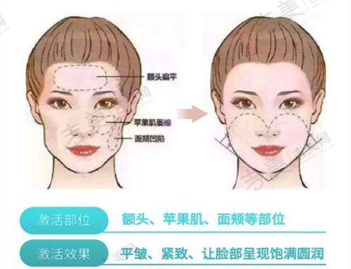 伊维兰5D童颜针脸部手术剂量配比方法