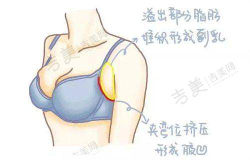 歌莉兰医用紧缩针原理之与其他疗法对比