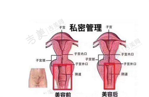 歌莉兰医用紧缩针原理之适用情况分析