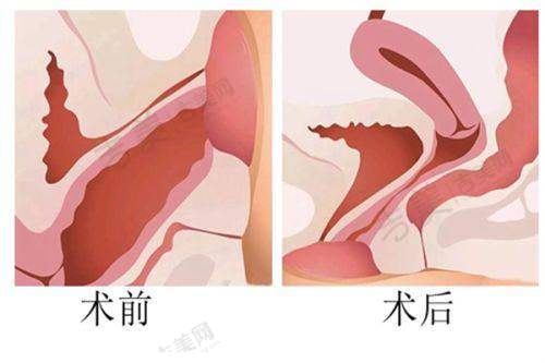 伊维兰童颜针的成分如何