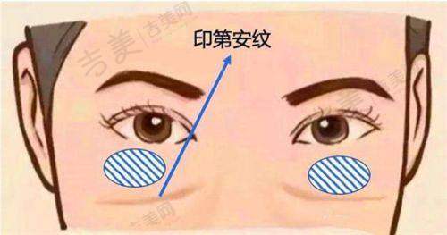 伊维兰童颜针的适用范围如何