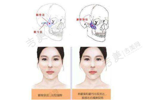 打紧缩针5个月感受之紧缩针优缺点全方面总结