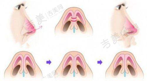 打紧缩针5个月感受之成效维持时间因人而异