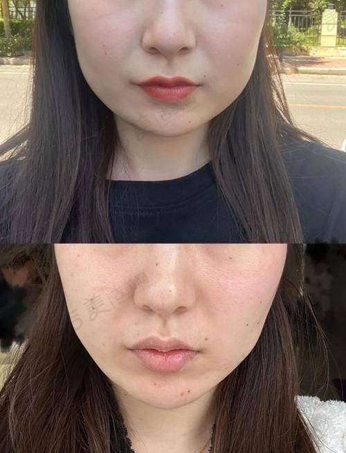 滕盛医生做完手术患者感觉如何