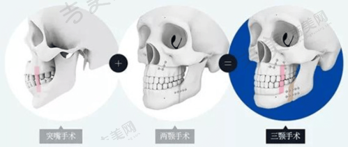 武汉徐国建无痕筋膜提升的价格优势体现在哪？