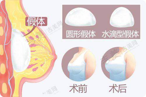赖岗椿做手术价格