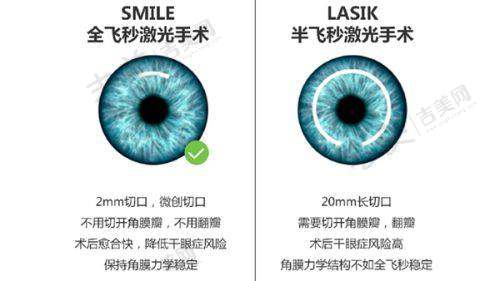 抚顺白内障免费政策还有哪些相关补贴?