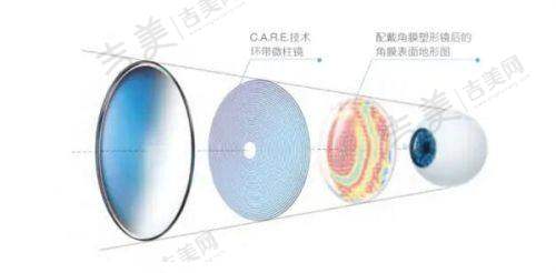 选择深圳眼科医院近视手术的注意事项及价格考量