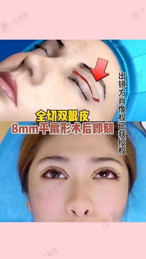 三、朱敏医生做手术价格