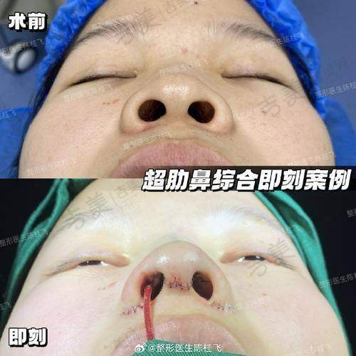 曹国伟医生做手术价格