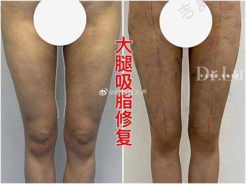 成都吸脂医生排名——成都艾米丽医疗美容整形潘红伟
