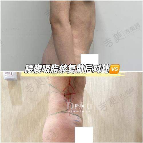 成都吸脂医生排名——成都军大整形美容医院雷子凌