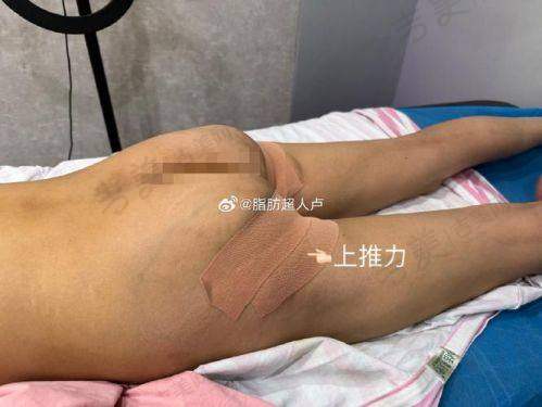 成都吸脂医生排名——成都西区医院宋华敬