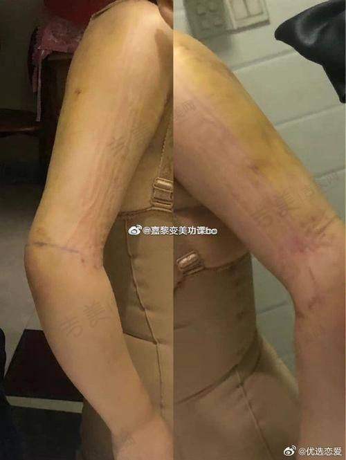 成都吸脂医生排名——排名前十医院名单