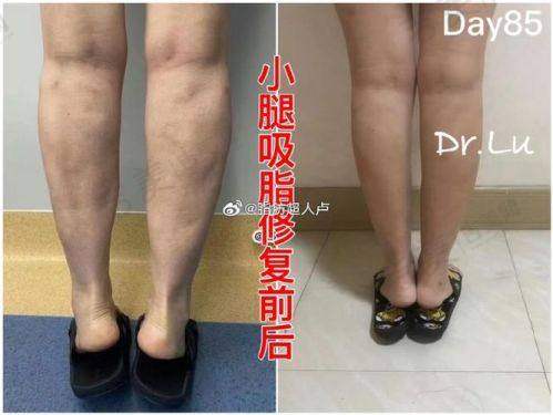 成都吸脂医生排名——成都东篱整形医院何先富