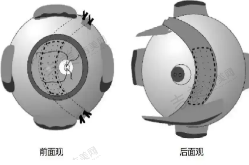 美佳医美医院脸部拉皮手术不同切口类型成效对比