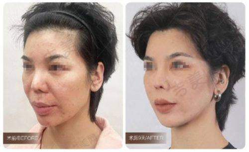 美佳医美医院脸部拉皮手术技术优势