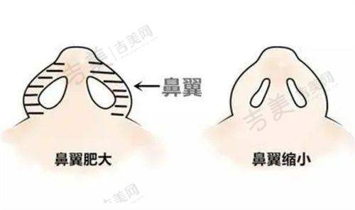 微拉美和无痕筋膜悬吊提升术价格对比详情
