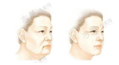 成都现代医疗美容医院唇裂二期修复的技术亮点