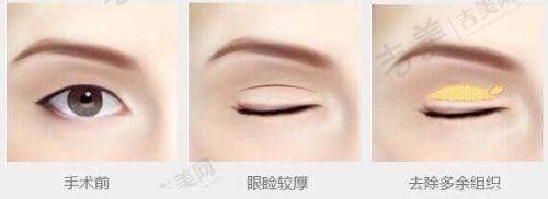 微拉美和无痕筋膜悬吊提升术顾客好评
