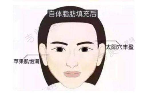 深圳朱冠峰医生祛眼袋手术实例展示