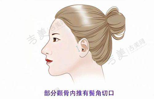 哈尔滨艺星整形医院双眼皮修复的安心保护