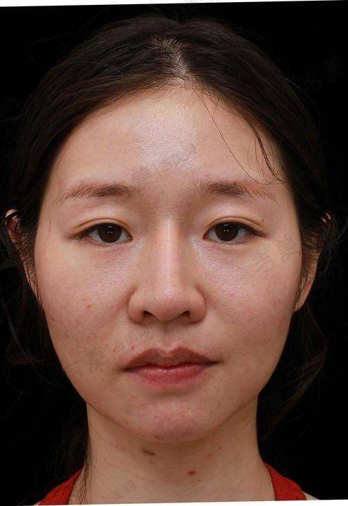 深圳安美聚光医疗美容门诊部彭喜医生的 6D 轮廓新生术
