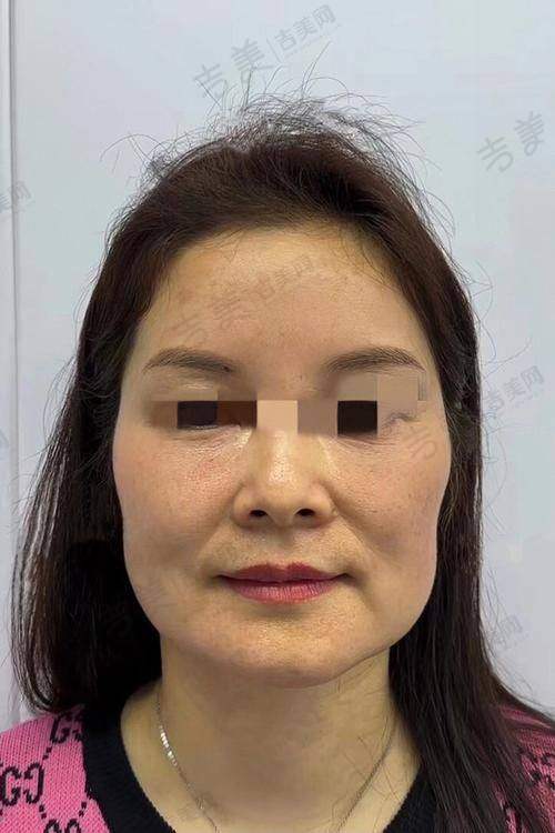 成都素美医疗美容门诊部李建钢医生手术成效看口碑如何