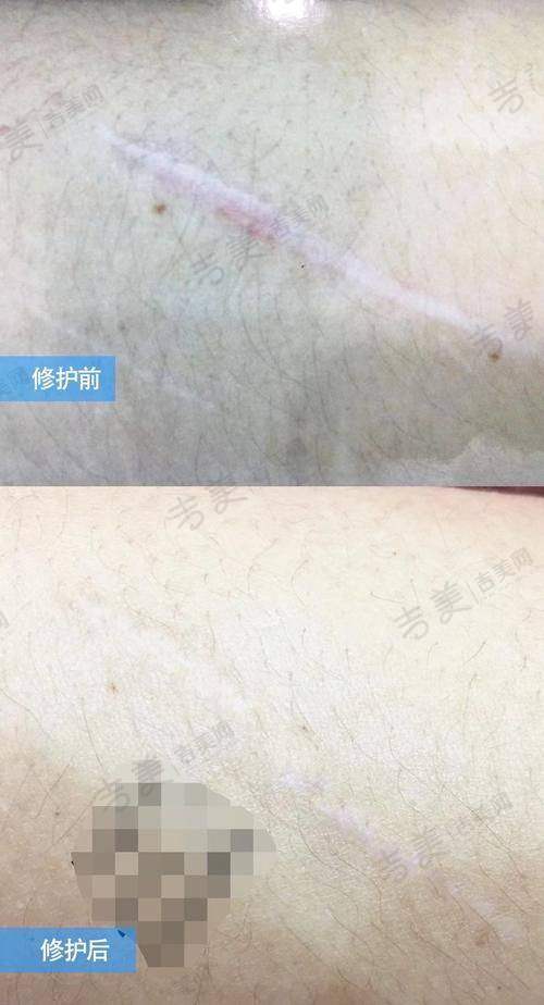 张维医生做完手术的感受分享