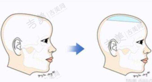 丰唇项目情况