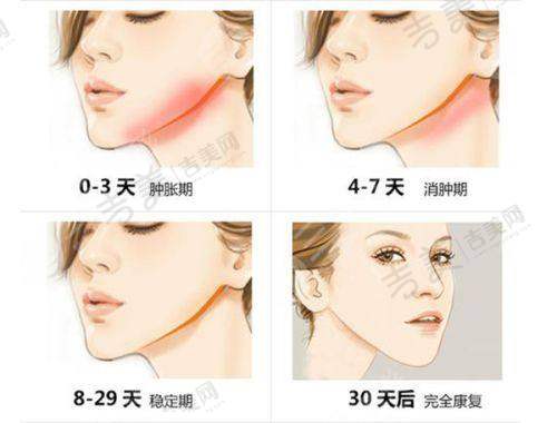 缩鼻项目情况