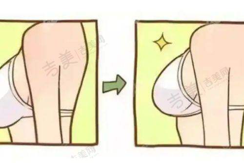 苏州乳头缩小哪个医生做的好——苏州市立医院整形外科