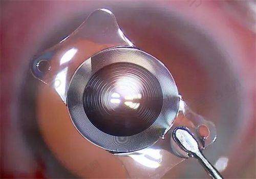 四川省人民医院眼科角膜塑形镜与配镜价格详情