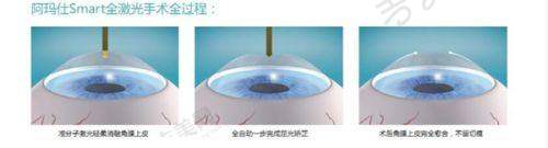 四川省人民医院眼科近视手术价格详情