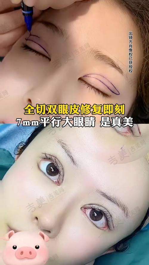 苏州外切祛眼袋预约哪个门诊——佛山华美整形美容医院