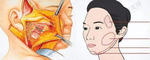 苏州大拉皮骨干医生排名前十——苏州康美整形美容医院