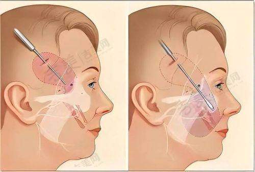 苏州大拉皮骨干医生排名前十——苏州紫馨美容医院