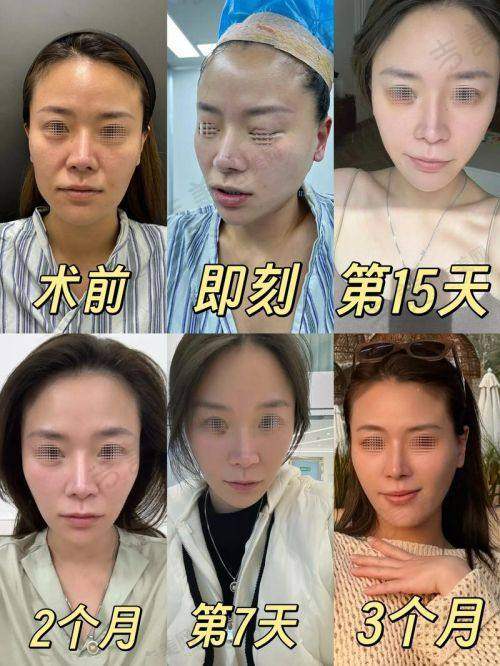 苏州大拉皮骨干医生排名前十——苏州爱思特医疗整形美容医院