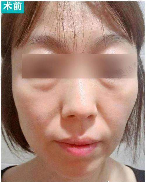 苏州大拉皮骨干医生排名前十——苏州圣爱整形医院