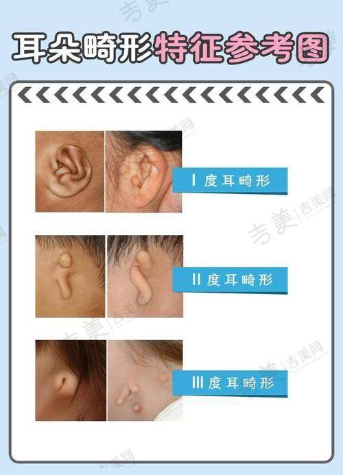 苏州做贴发耳整形医生排名前三——苏州大学附属第二医院整形美容科