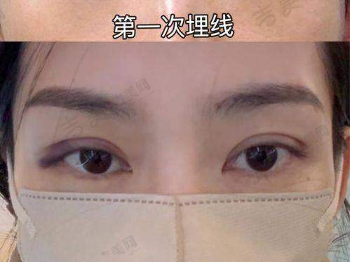 苏州外切祛眼袋预约哪个门诊——上海美莱医疗美容门诊部