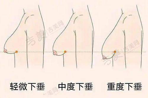 北京新星靓整形酷塑冷冻减脂项目亮点