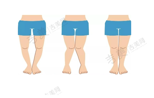 北京丽合医疗美容医院酷塑冷冻减脂优势