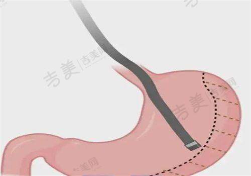 长沙禾丽整形医院取奥美定创新技术