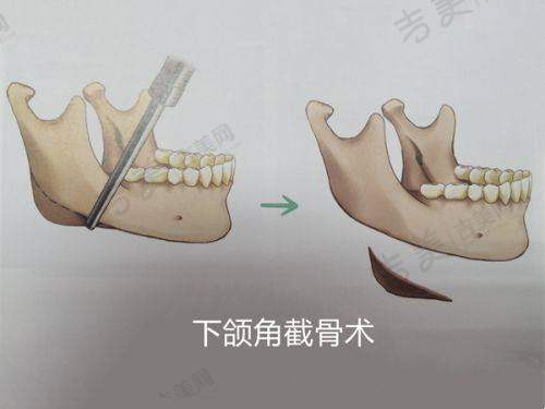 北京美中宜和丽都院区酷塑冷冻减脂技术特点