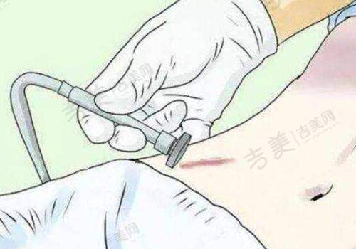 长沙异物取出好的医院排名及特色