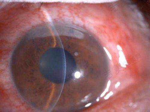 四、象山爱尔眼科医院特色项目介绍