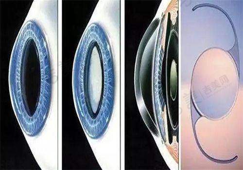 江门五邑爱尔新希望眼科收费情况