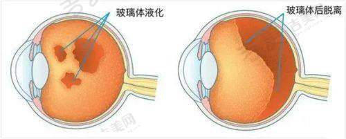 郑州医院2025年白内障手术申请条件解析
