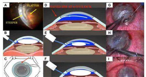 郑州医院2025年白内障手术申请流程介绍
